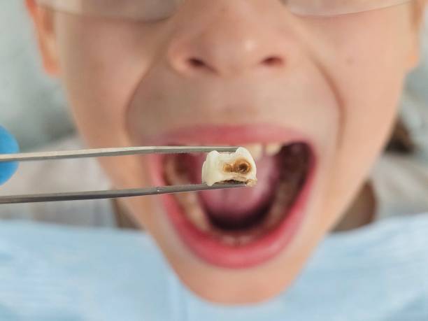 Best Emergency Dentist for Lost Fillings or Crowns in Mount Carmel, OH